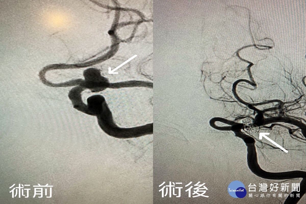 動脈瘤術前與術後的比對。