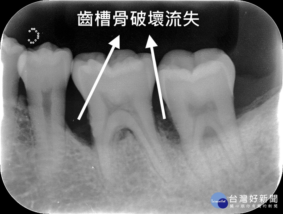 牙周病是牙齒清潔不徹底 北榮桃分院教您保護清潔牙齒