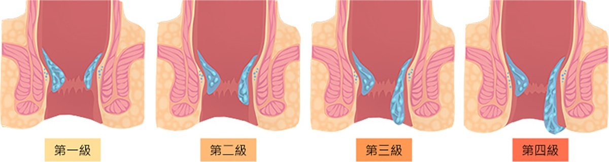 痔瘡的分級。(圖/禾馨直腸外科)