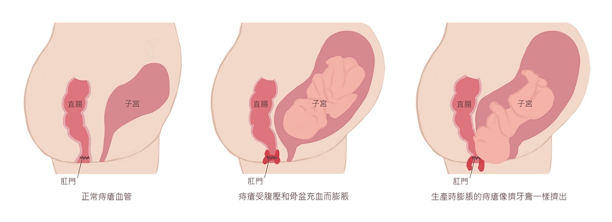 (圖/禾馨直腸外科)