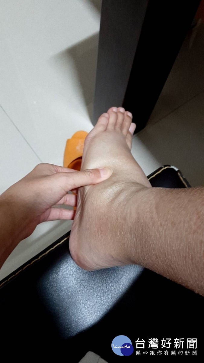 李小姐之前水腫的腳,以為是發胖忙減重,引發紅斑性狼瘡。圖/彰化醫院提供