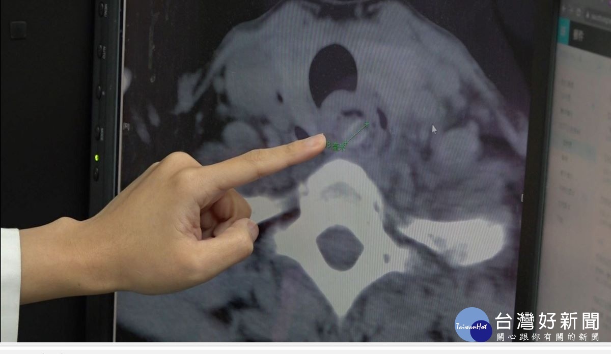 電腦斷層顯示患者食道有紅棗核卡住，並且造成周圍有膿瘍的情形。圖／記者鄧富珍攝