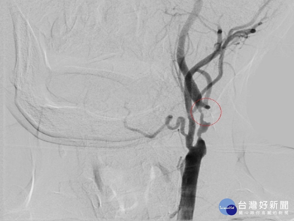 老翁頸動脈阻塞頭暈無力　家屬警覺送醫避免腦中風喪命