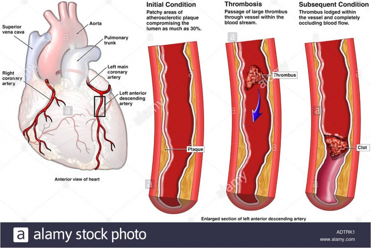 「心肌梗塞」也是血管阻塞所引起的疾病。