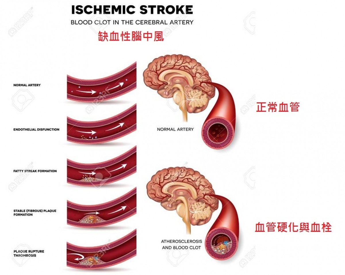 「阻塞性腦中風」血管阻塞引起的疾病。