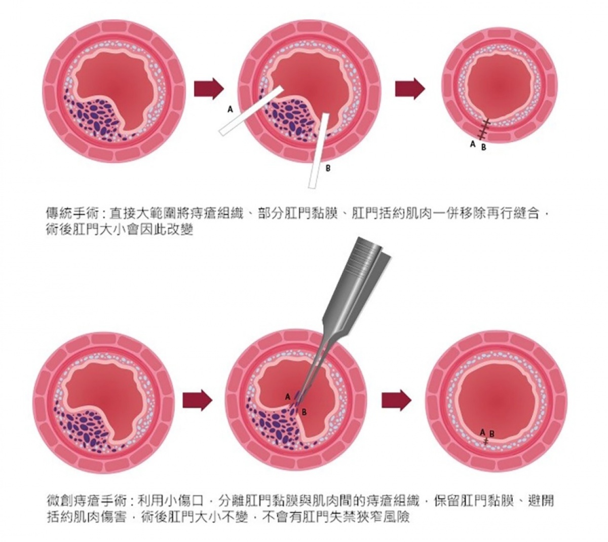 傳統痔瘡手術與微創痔瘡手術。（圖／禾馨直腸外科）