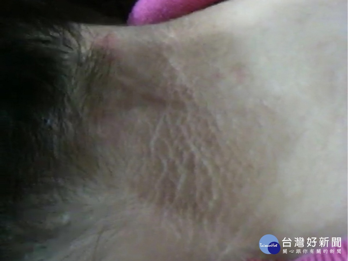 患多囊性卵巢症女性要小心 感染新冠肺炎機率高正常51%