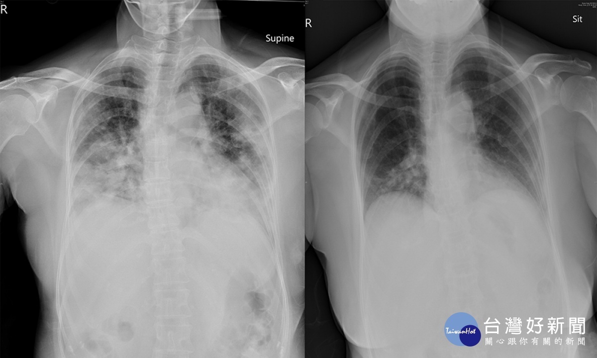 該患者入院時X光片可見雙側肺葉嚴重浸潤(左)，出院前可看到浸潤狀況有很大程度改善(右)／陳致愷翻攝