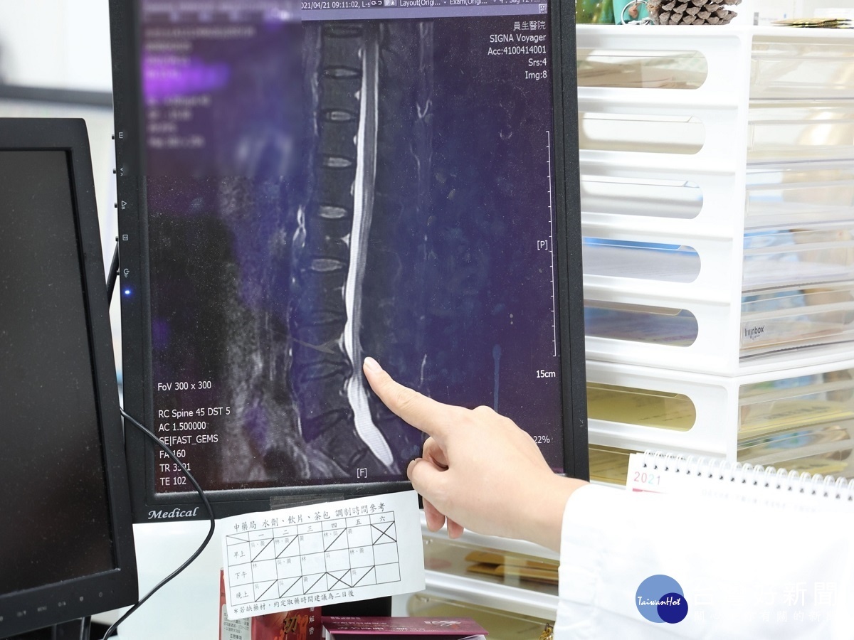 男子工作關係引發急性腰痛 求助中醫配合針灸與針刀鬆解重獲新生