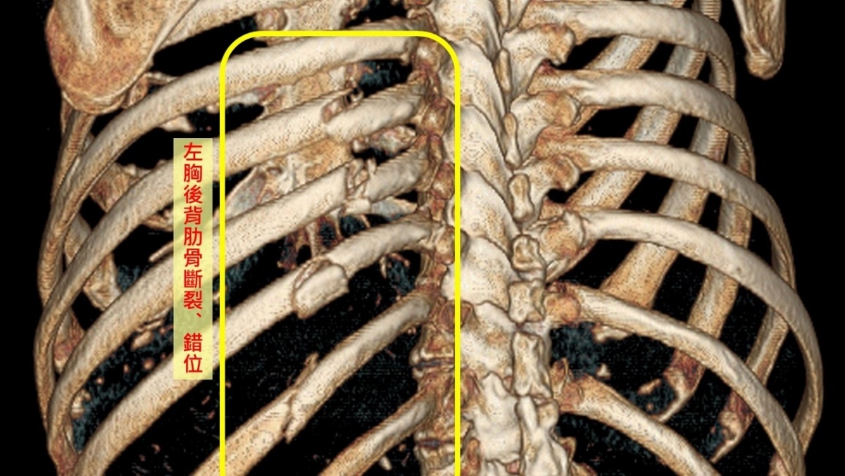 電腦斷層掃瞄影像顯示廖先生肋骨斷裂、錯位。