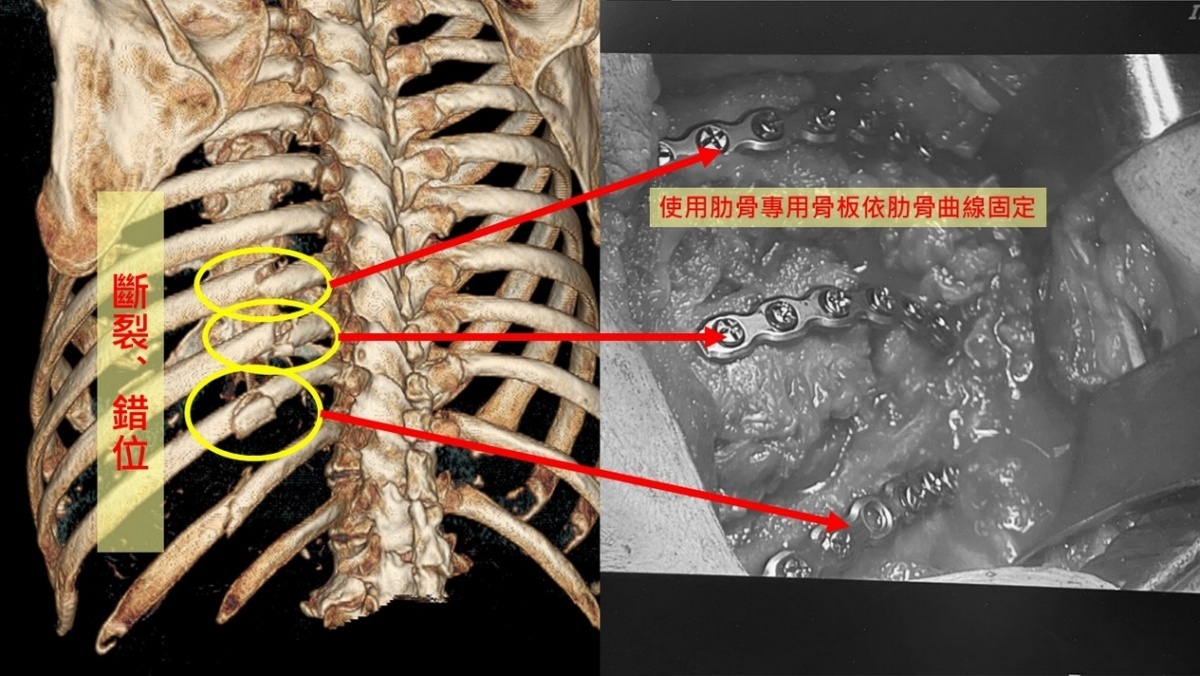 吳政元主任採用肋骨專用鈦合金骨板為廖先生固定骨折、錯位肋骨，避免疼痛。