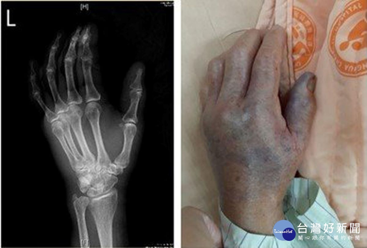 阿嬤的左手幾個小時後演變成壞死性筋膜炎，經送醫後迅速確診為「創傷弧菌」感染。圖／彰基醫院提供